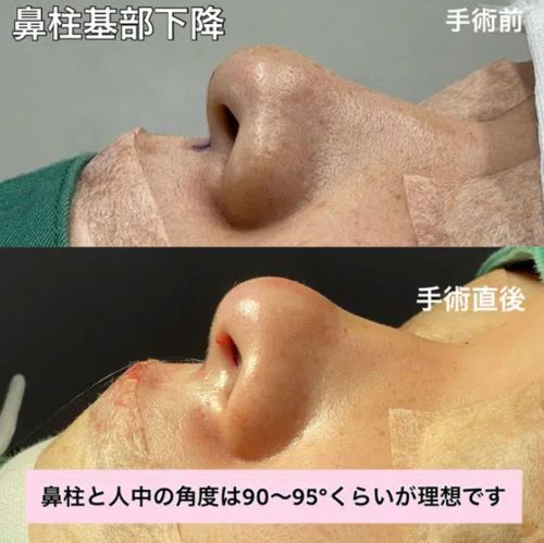 【鼻整形】鼻中隔延長と鼻柱基部下降を比較解説