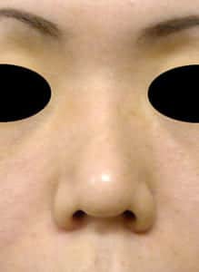 鼻柱基部下降①正面手術前