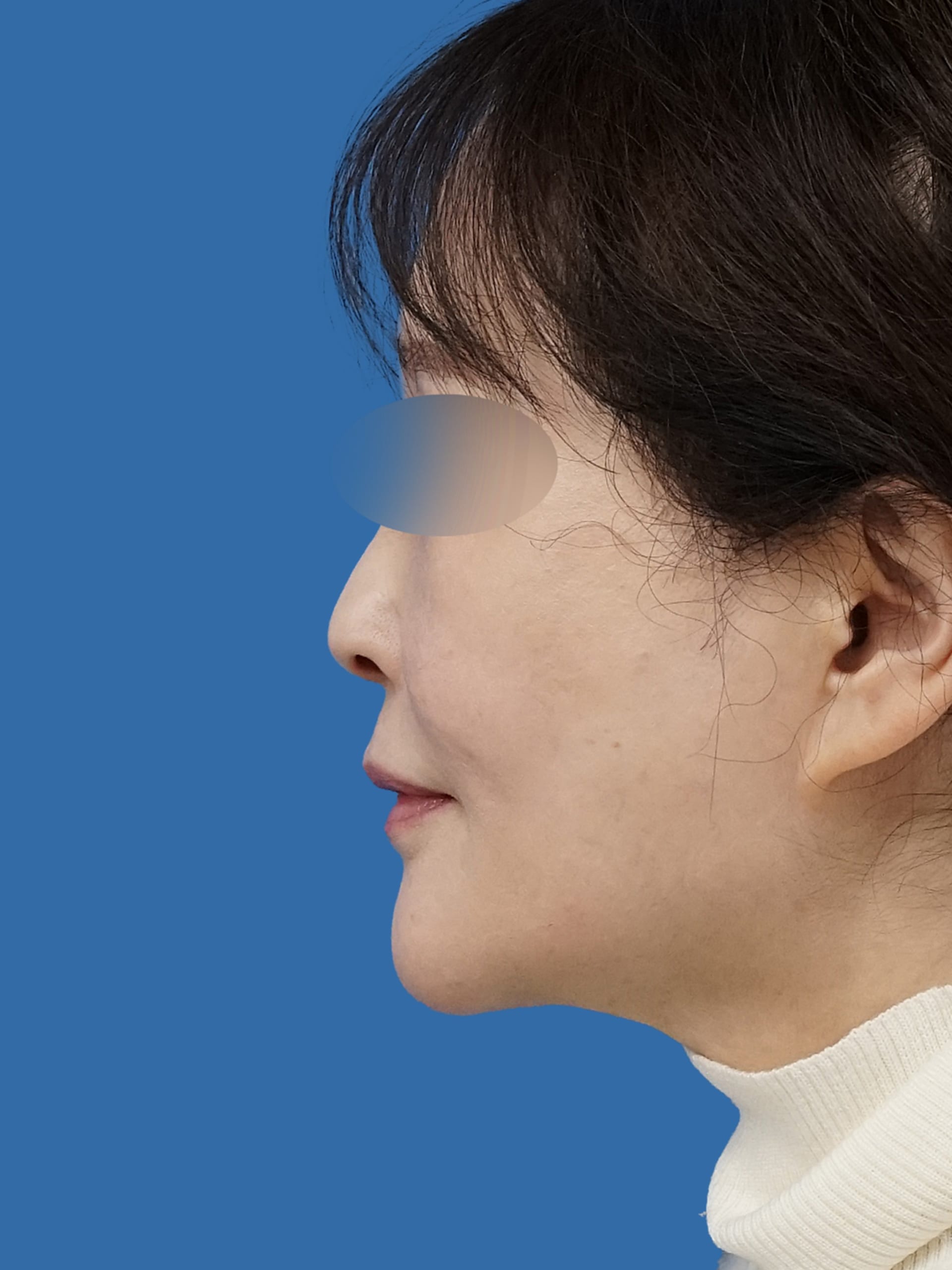 VOVコグリフト 側面 術前vs術後3か月のAfterの写真