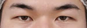 症例写真⑨ 手術前