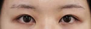 症例写真③6ヶ月後