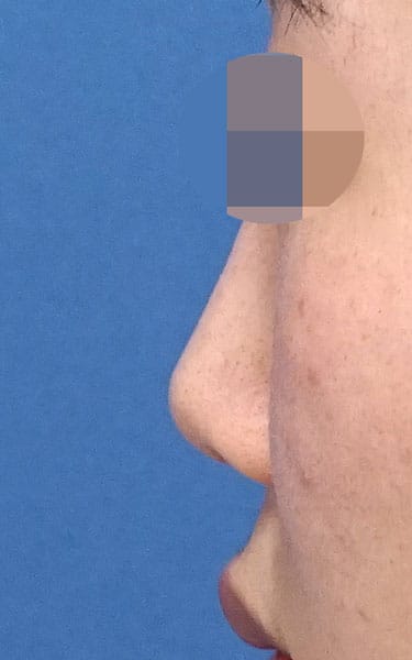 ミスコ(切らない鼻尖延長) 1週間後 左側面のBefore写真