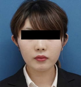 ⑧正面1ヶ月後