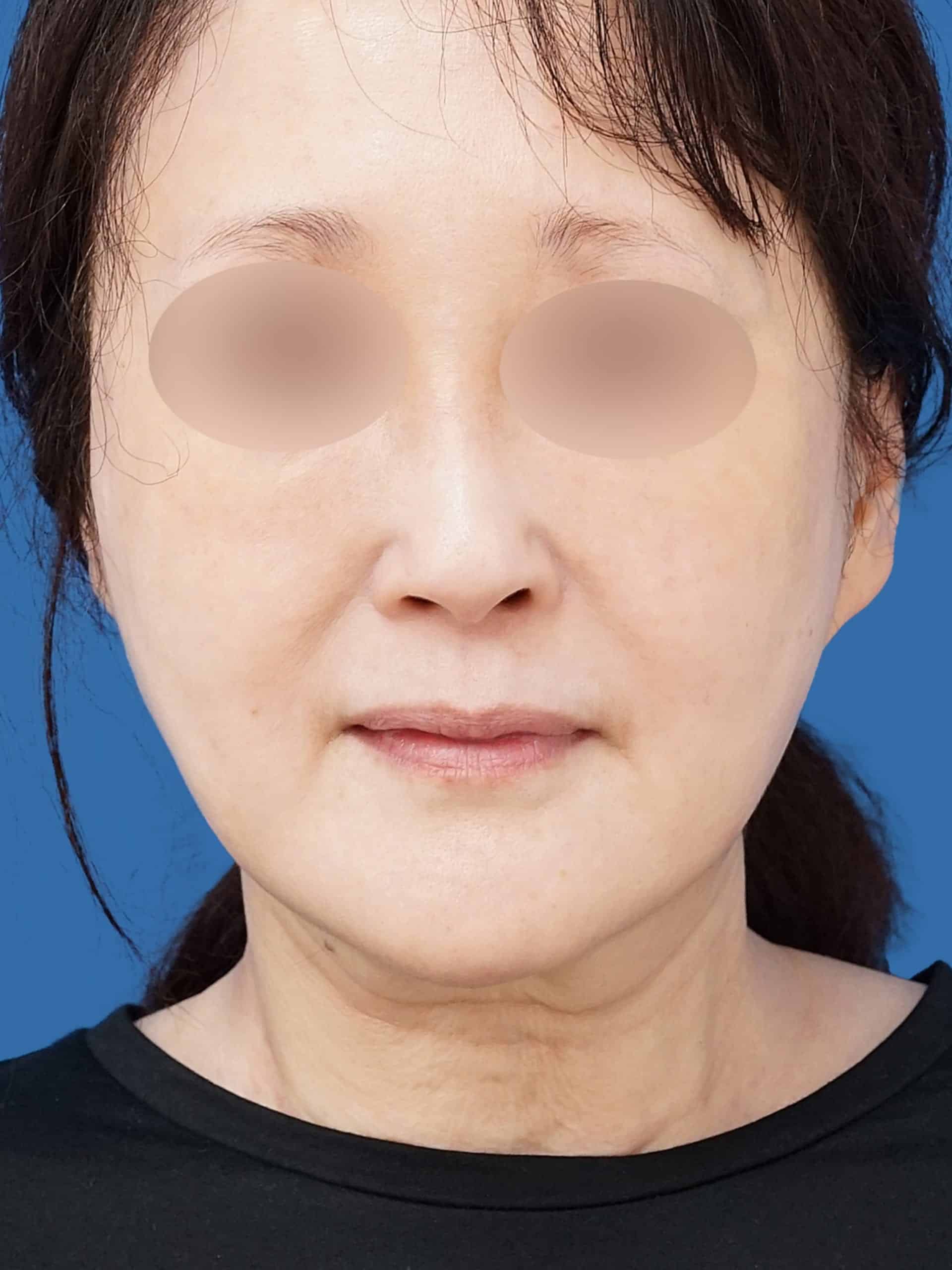 VOVコグリフト 正面 術前vs術後3か月のBefore写真
