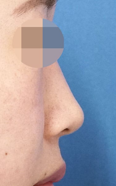 ミスコ（切らない鼻尖延長）　１か月後　右側面のAfterの写真