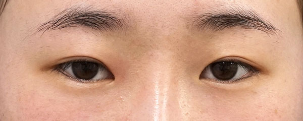 目頭切開Z形成、目尻切開、二重埋没法（もとびアイライト）　6ヶ月後　正面のBefore写真