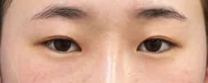 目頭切開Z形成、目尻切開、二重埋没法（もとびアイライト）　6ヶ月後　正面