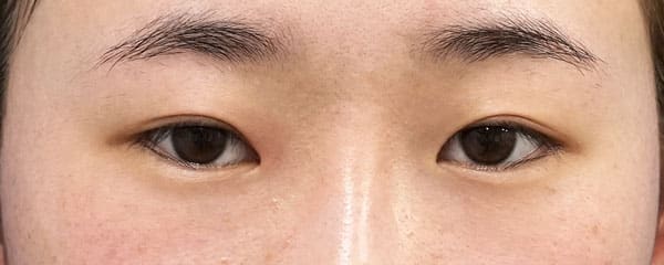 目頭切開Z形成、目尻切開、二重埋没法(もとびアイライト) 6ヶ月後 正面のBefore写真
