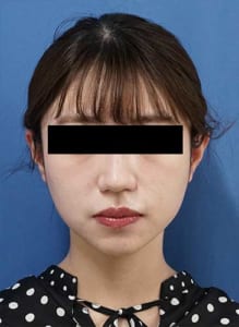 ①正面1ヶ月後