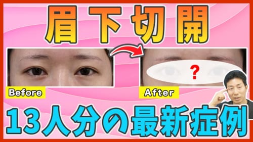 最新の眉下切開の症例写真を一挙解説（Part3）