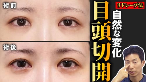 リドレープ法はどんな人に向いてる？症例写真も用いて徹底解説