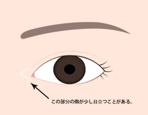 目頭切開Z形成の目立ちやすい