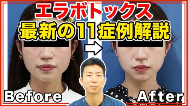 最新のエラボトックスの症例写真を一挙解説