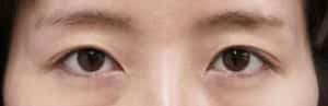 ③術後