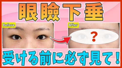 眼瞼下垂治療で目元の印象はどのくらい若返る？症例写真をもとに解説