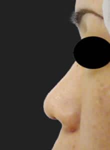 鼻柱基部下降①左側面手術前