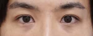 ⑤1ヶ月後