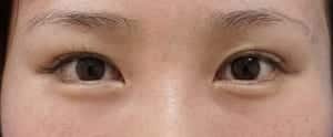 切らないたれ目1週間後