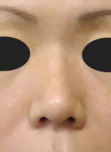 鼻柱基部下降①正面半年後
