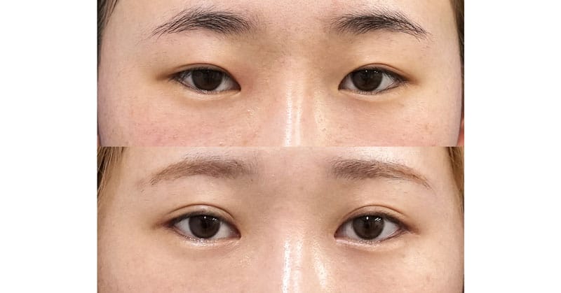 組み合わせ手術で目を大きく　目頭切開Z形成、目尻切開、二重埋没法（もとびアイライト）　6ヶ月後