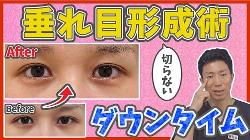 切らないたれ目形成のダウンタイム