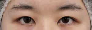 症例写真③手術前