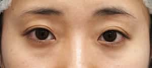 ③術前
