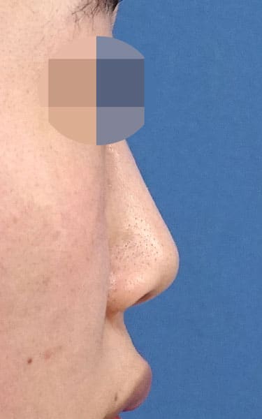 ミスコ（切らない鼻尖延長）　１週間後　右側面のBefore写真