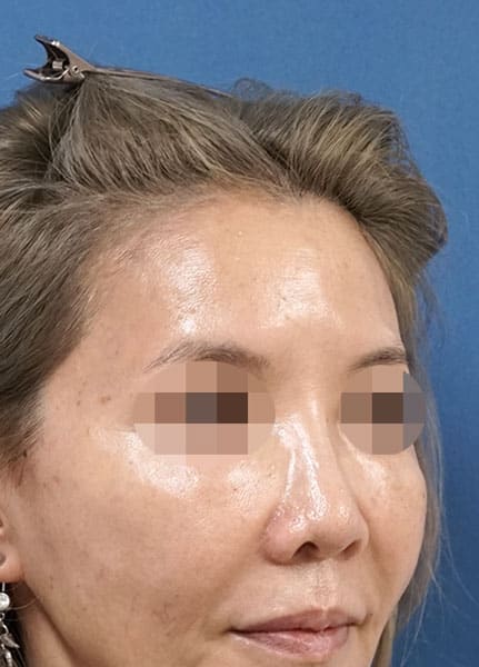 額ヒアルロン酸（ボリューマ）　２週間後　右斜めのBefore写真