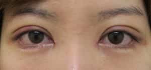 もとびアイプラチナム、下眼瞼下制、目頭切開1週間後