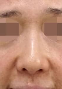 鼻尖縮小(3D)+耳介軟骨移植 正面 術前