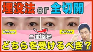 【二重整形】埋没法と全切開法のどちらを受けるべきか症例写真とともに解説
