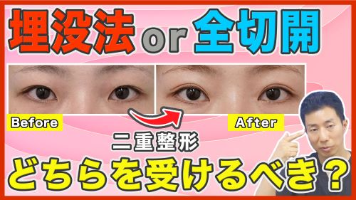 【パッチリした二重になりたい】埋没法と切開法、メリット・デメリットを改めて比較してみました