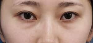 下眼瞼下制+目の下脂肪とり手術前