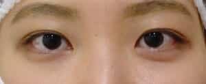 ⑤手術前