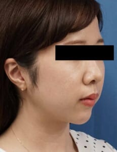 右ナナメ 1か月後