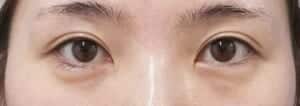下眼瞼下制、目尻切開手術前