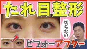 サムネ　切らないたれ目整形のビフォーアフター