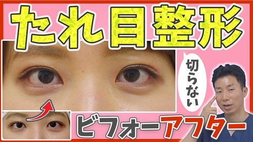 切らないたれ目形成のビフォーアフター