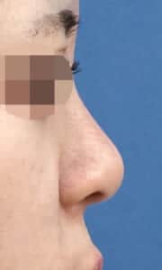 鼻尖縮小+軟骨移植、鼻孔縁延長 右側面 3ヶ月後