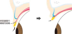 天然の二重の人が二重ができる仕組み