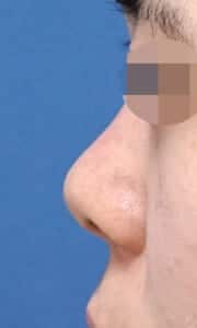 鼻尖縮小+軟骨移植、鼻孔縁延長 左側面 手術前