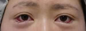 下眼瞼下制直後