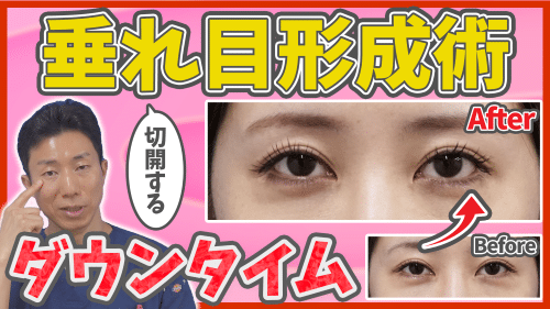 切開する垂れ目形成術のダウンタイムについて解説