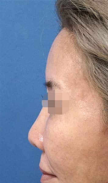 額ヒアルロン酸（ボリューマ）　２週間後　左側面のBefore写真