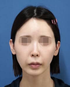 ホホ・貴族処置前