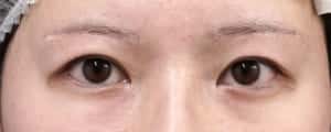 他院眉下切開修正手術　術前