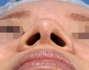 鼻尖縮小と小鼻縮小の併用 手術前下から手術前