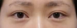 下眼瞼下制手術前