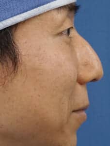 右側面術前